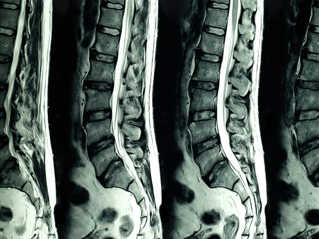MRI showing disc degeneration