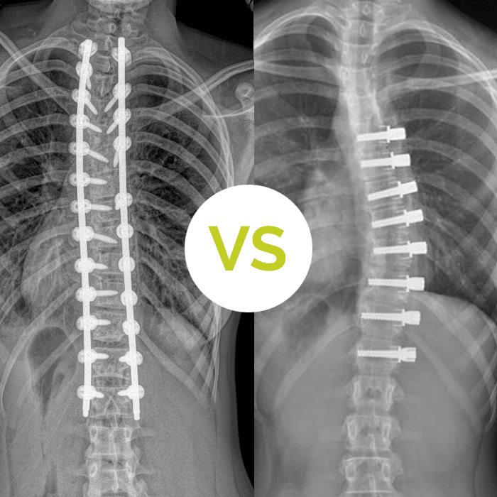 vbt vs psfusion for scoliosis