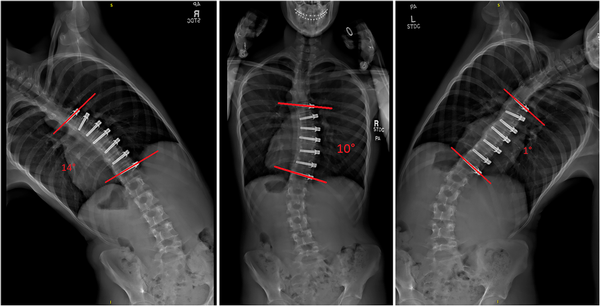 vertebral body tethering allowing bending