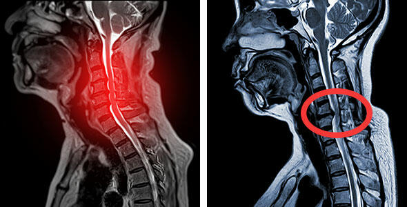 cervical myelopathy MRI