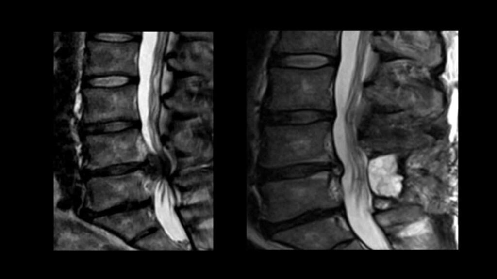 Cauda Equina syndrome - complete occlusion of the Lumbar spinal canal and compression of the nerves