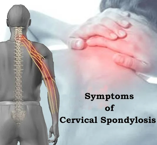 Illustration of degeneration of cervical spine