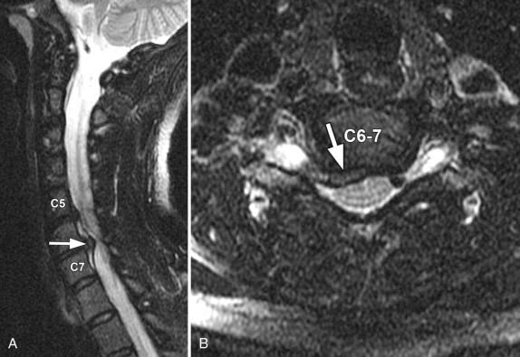 Cervical Disc Prolapse/ Disc Bulge Cervical Disc Prolapse