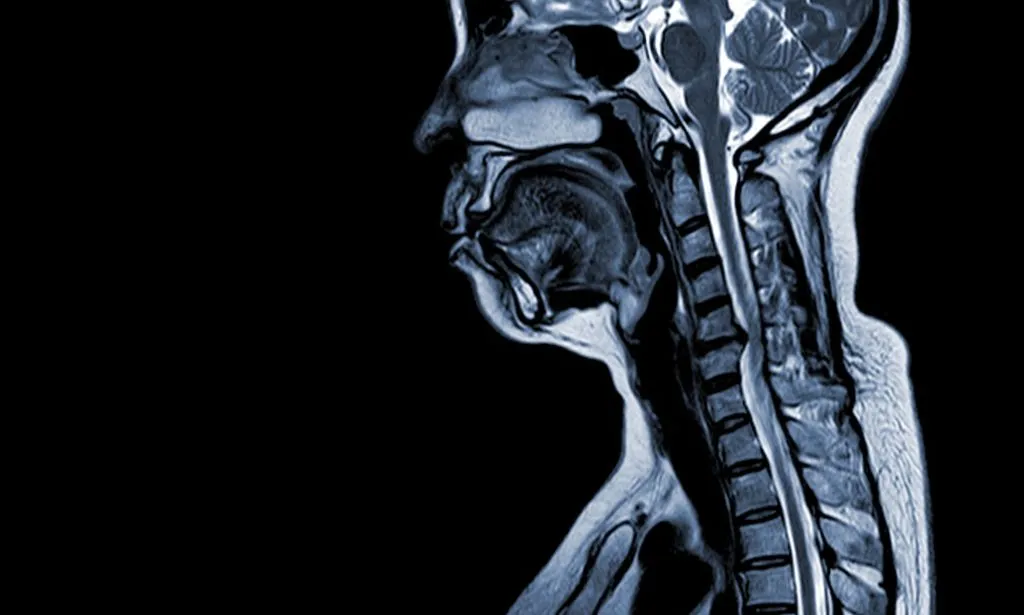 Compression of the spinal cord