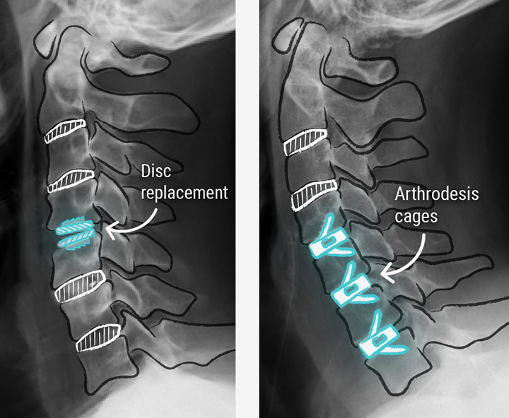 Cervical Disc Prolapse/ Disc Bulge Cervical disc replacement over fusion