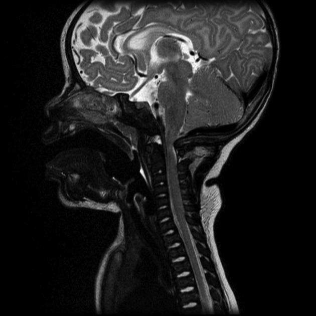Craniovertebral Junction Compression