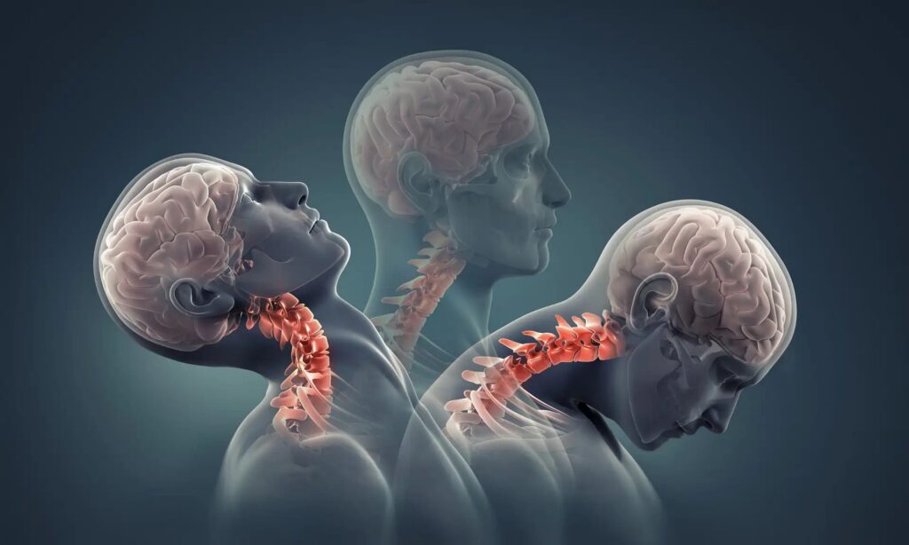 Craniovertebral Junction 