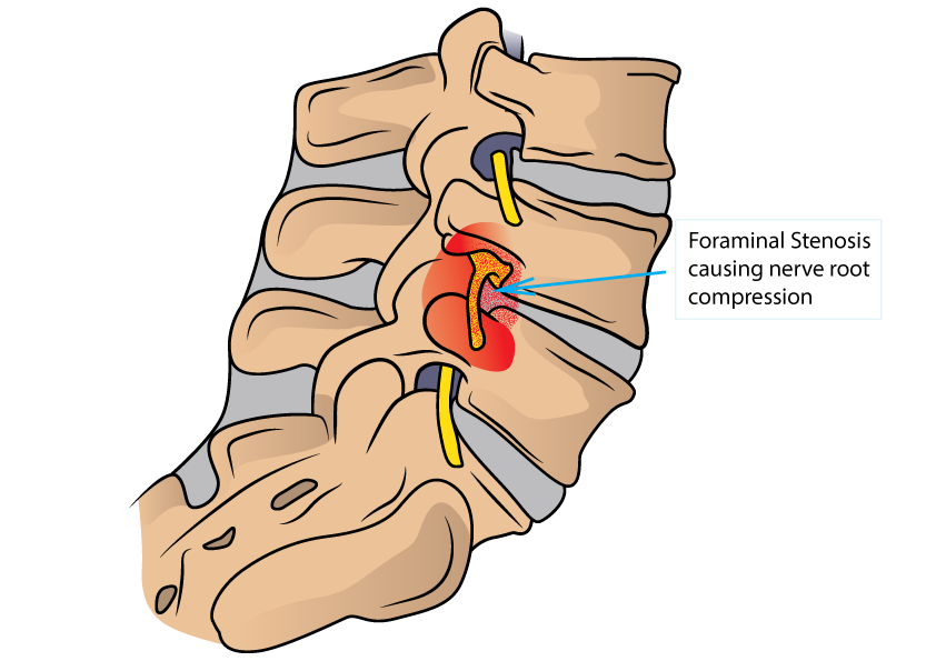 lumbar stenosis causing compression of the nerve root
