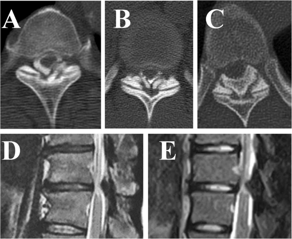Ossification of Ligamentum Flavum