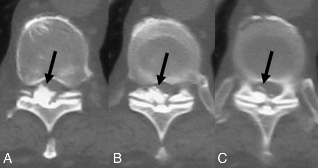 Ossification of Ligamentum Flavum