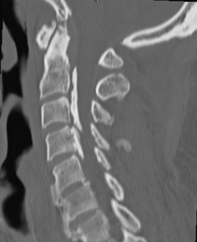 Ossified Posterior Longitudinal Ligament