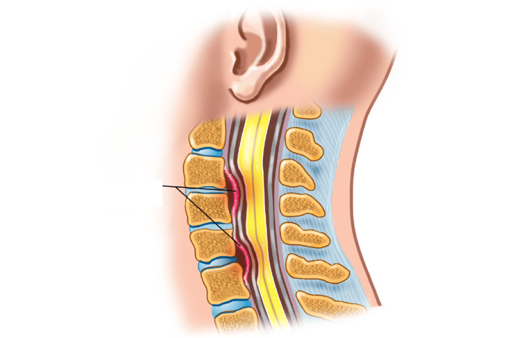 Ossified Posterior Longitudinal Ligament