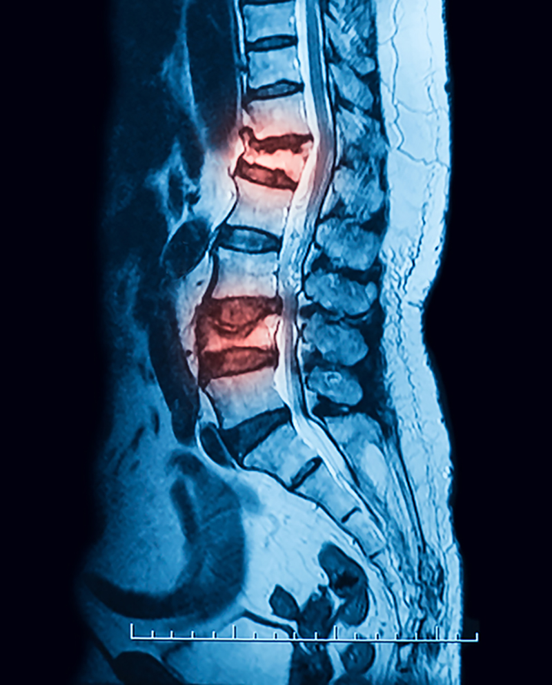 Osteoporotic compression fracture