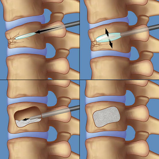 Kyphoplasty restoring the vertebral body height
